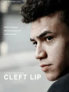 Cleft Lip